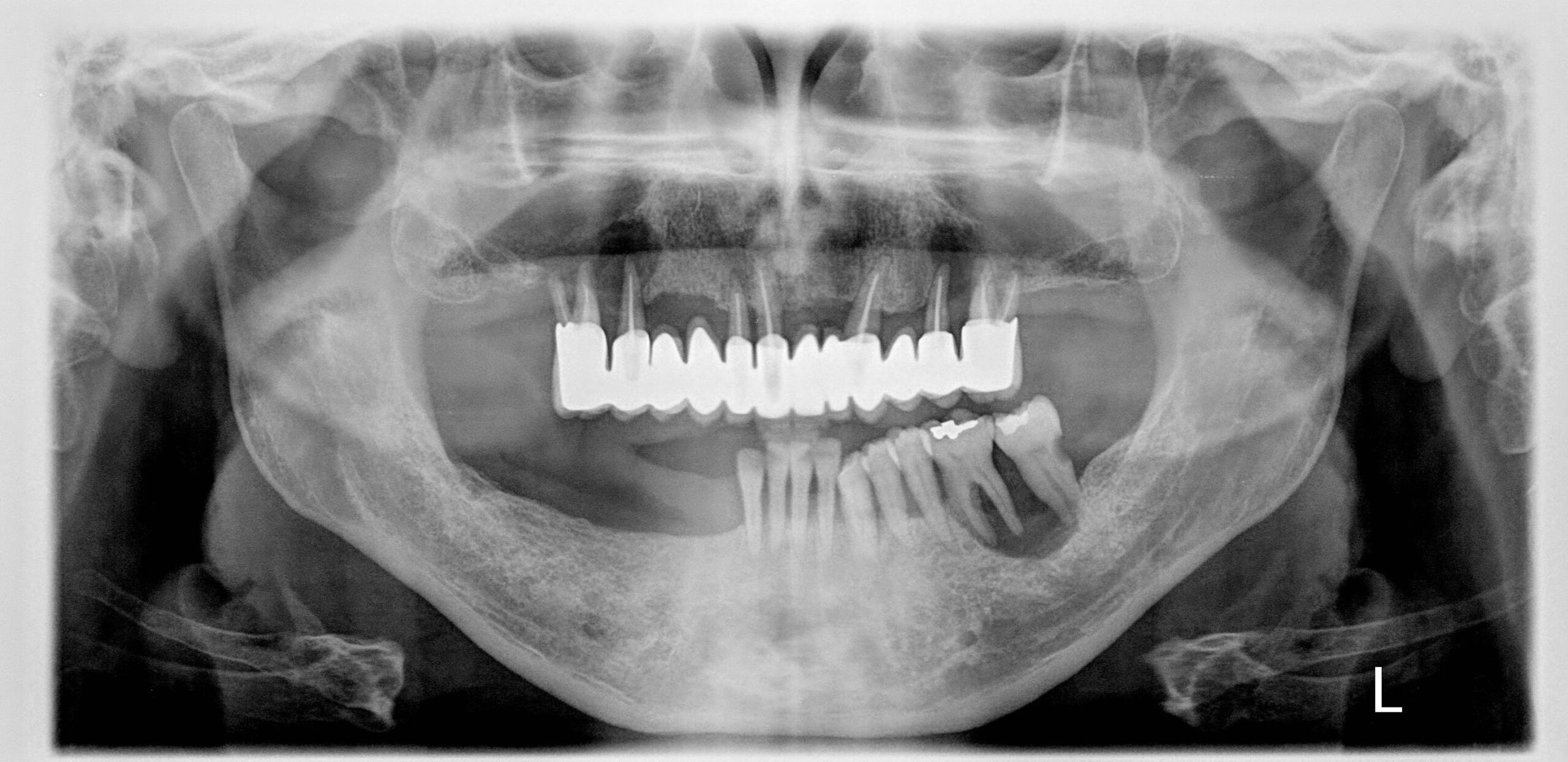 Eosinophilic granuloma