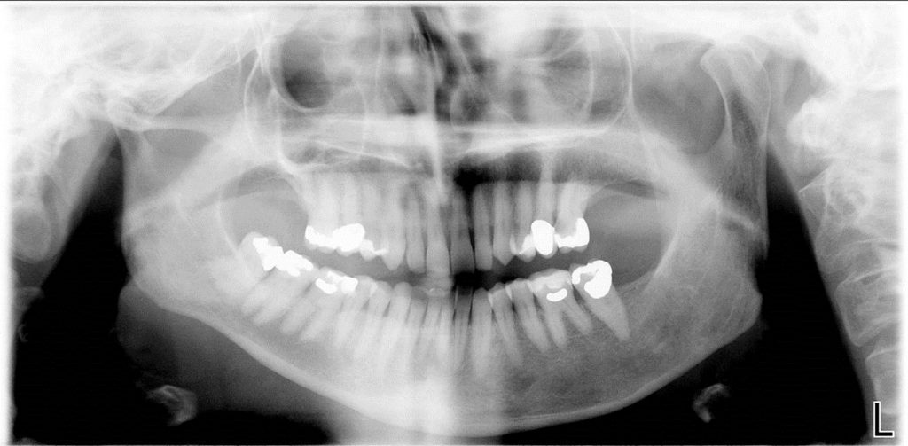 Hyperplas1-1024x503-1