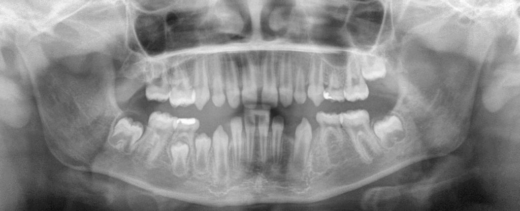 HypodontiaOPT-1024x416-1