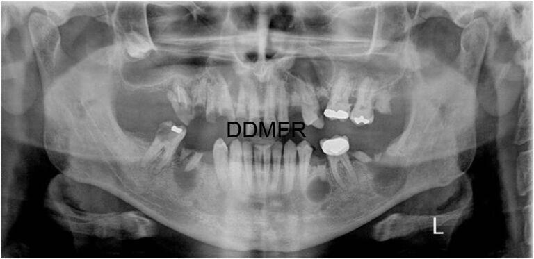 Multiple-cysts-768x373
