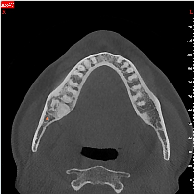 Ossifyying fibroma