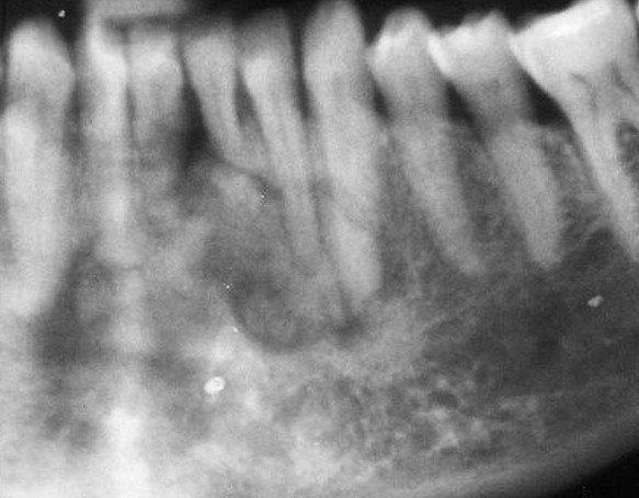 cementoblastoma1mixed