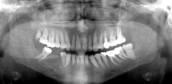 hyperparathyroidism1c