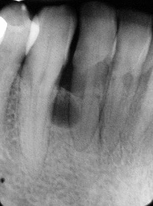 periodontalcyst1