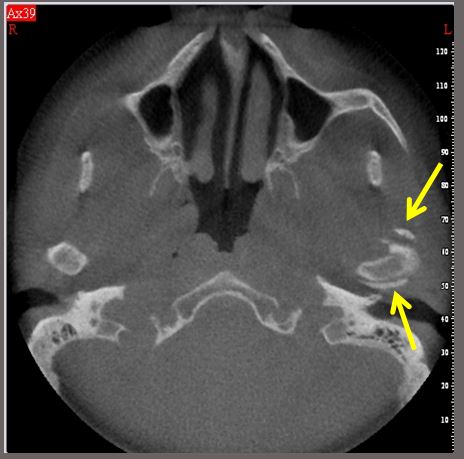 Synovial chondromatosis
